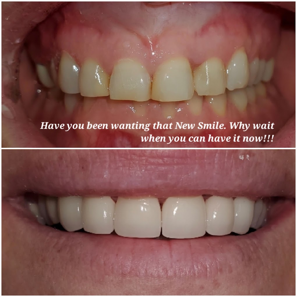 Dental bonding results - beautiful smile