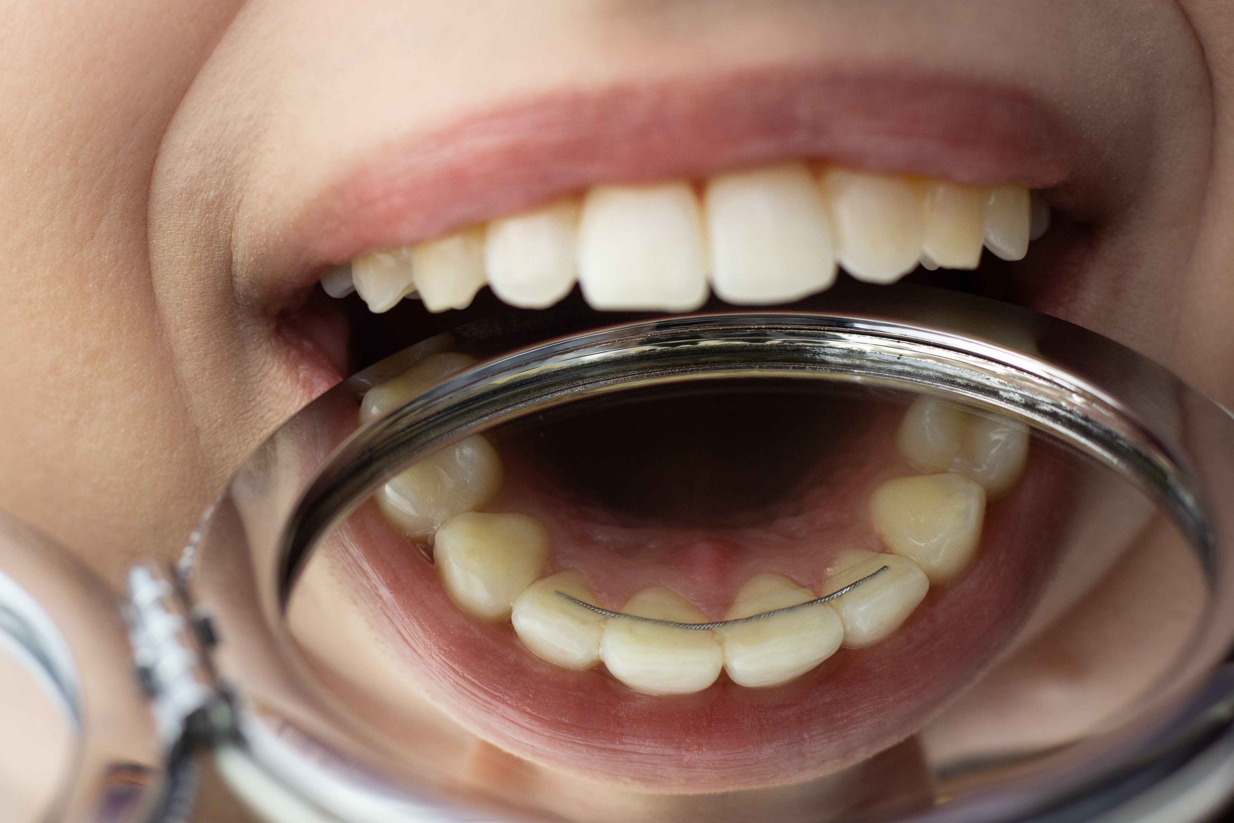 Fixed retainers Corona permanent