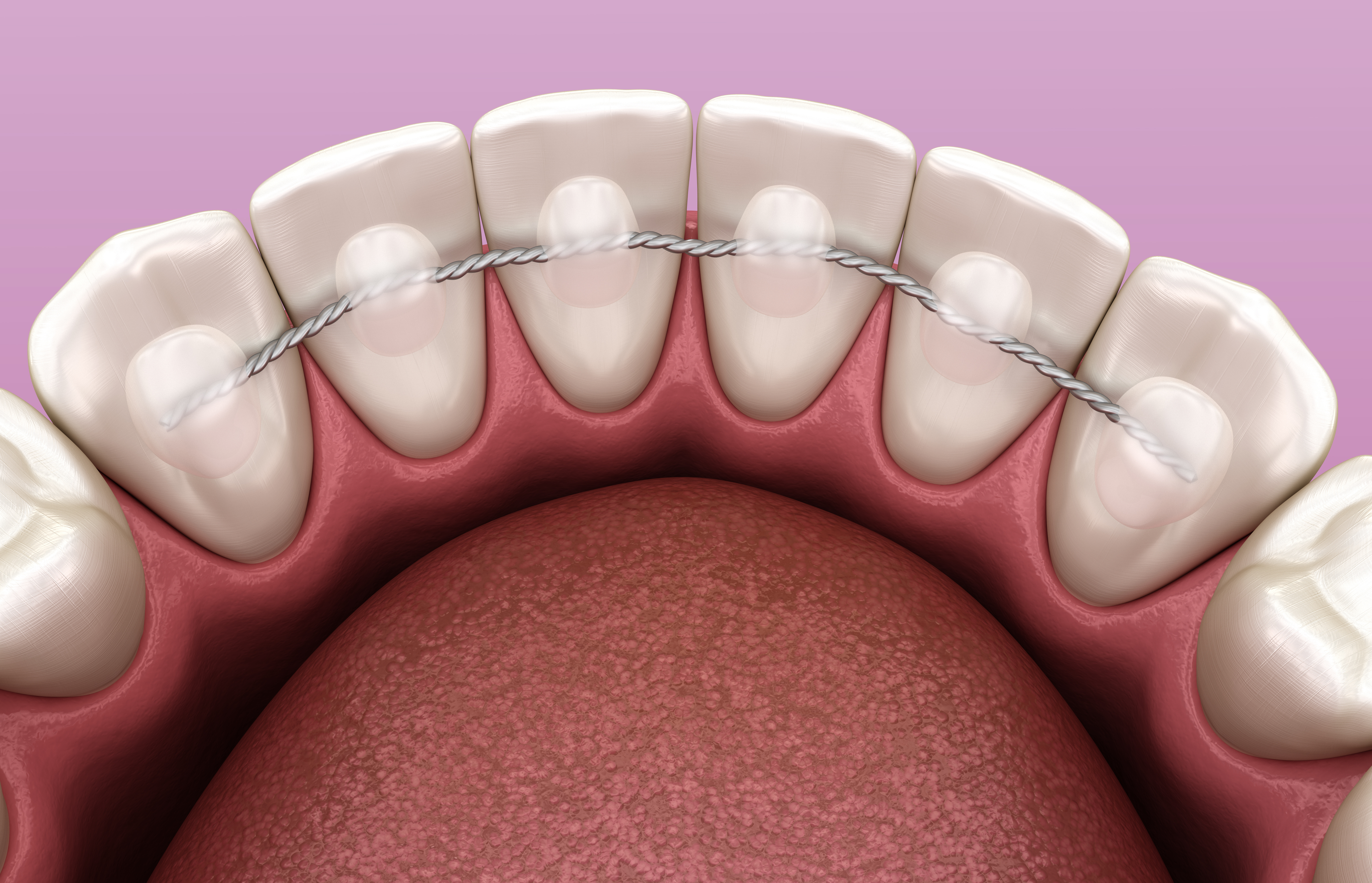Permanent retainer Corona CA close-up view