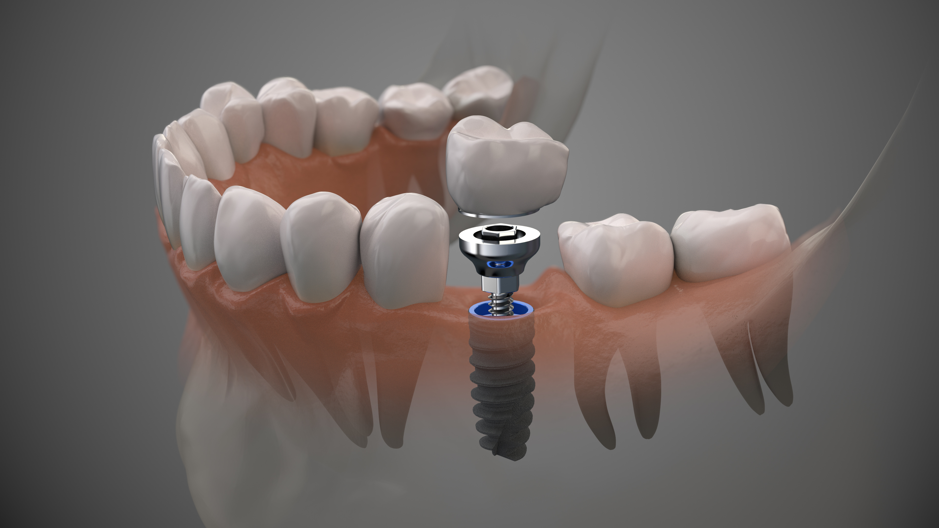Dental implant procedure