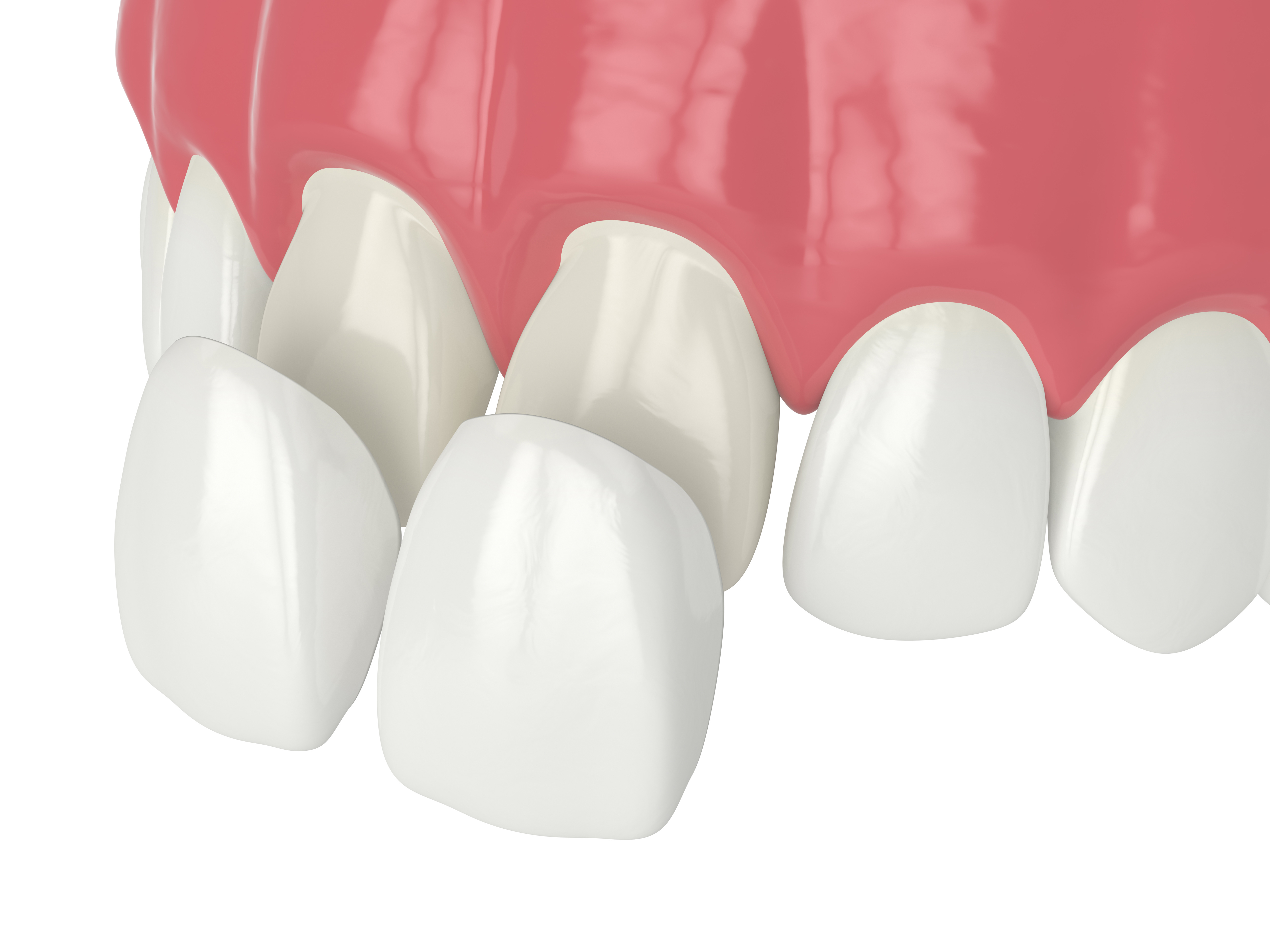 Veneer smile transformation